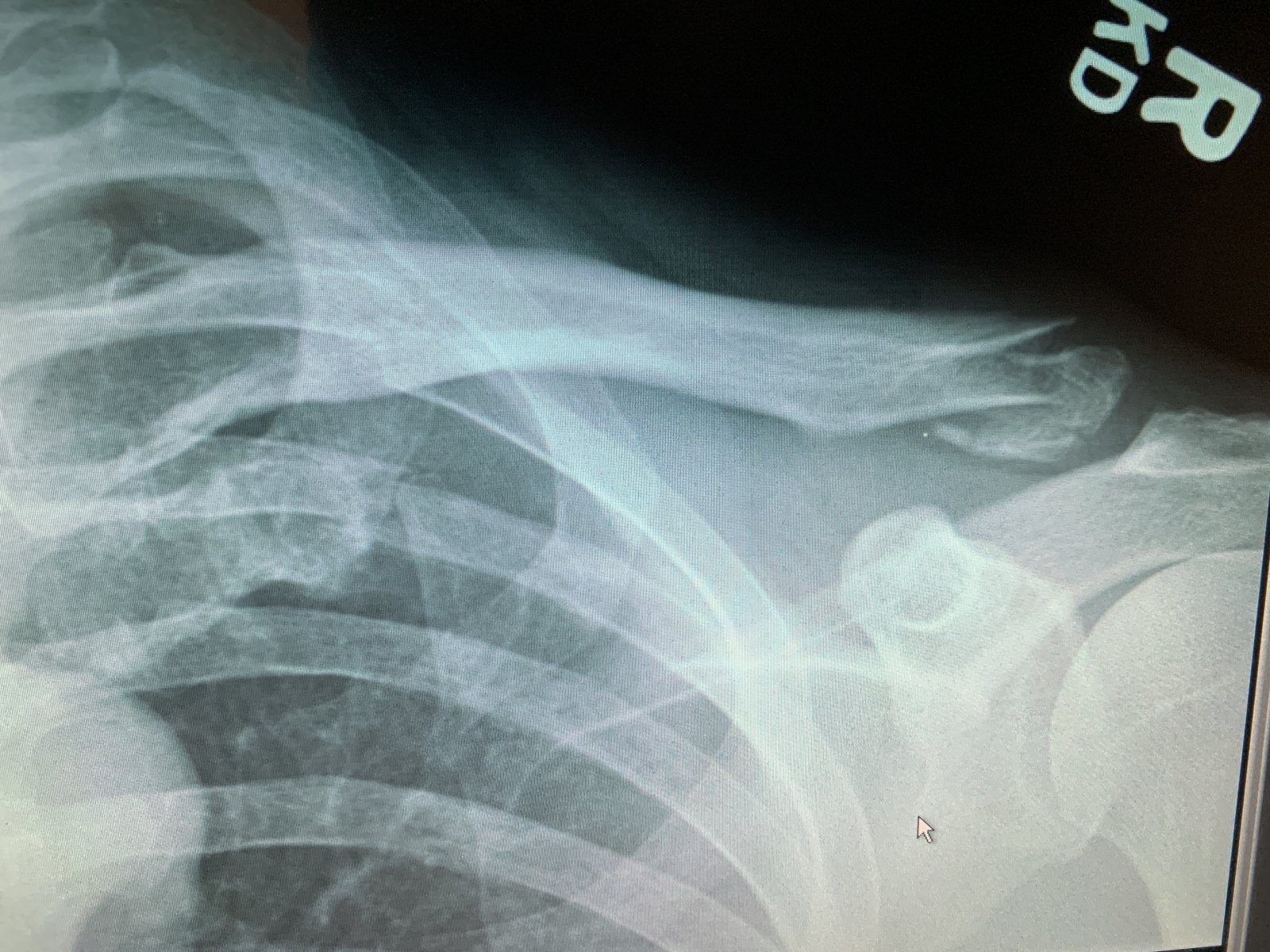 collar bone 3 weeks later.JPG