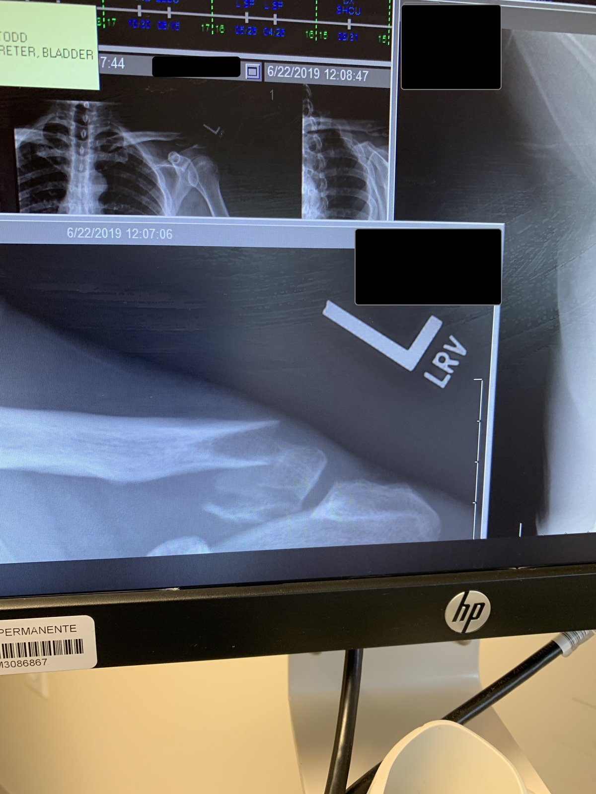 collar bone ER.JPG