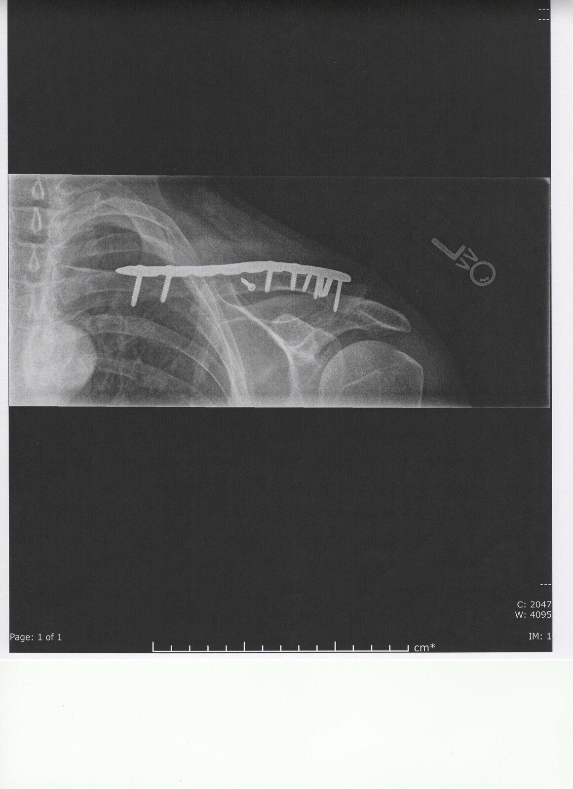 Collarbone repair.jpeg