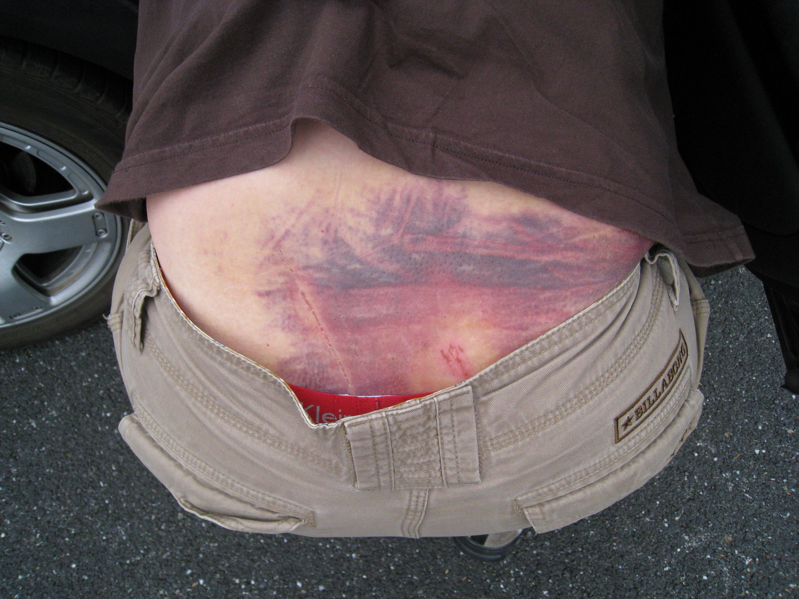 Shorts Bruise1.JPG